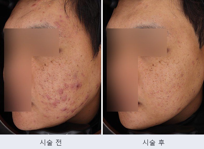 여드름 붉은자국